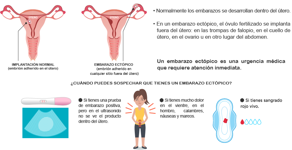 infografía del embarazo ectópico